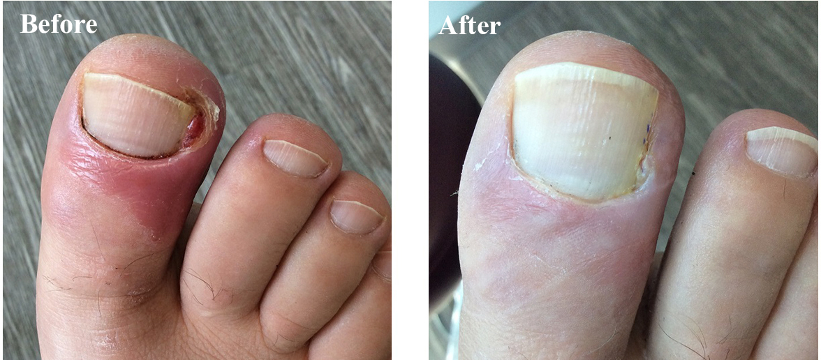 Before After Photos Foot And Ankle Wellness Centre