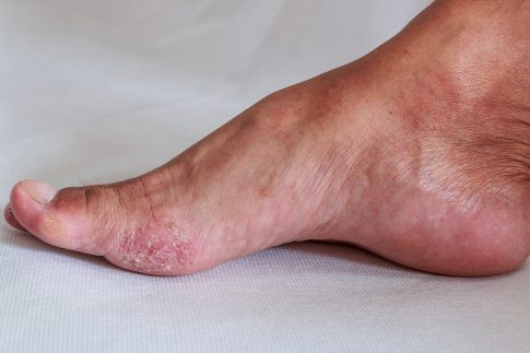 A photo of a foot with athlete's foot.