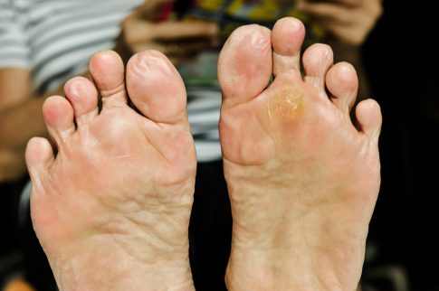 https://edmontonfootdoc.com/wp-content/uploads/2016/11/exterior-callous-and-corns-1-485x322.jpg