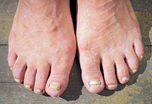 A closeup of feet with fungal toenails.