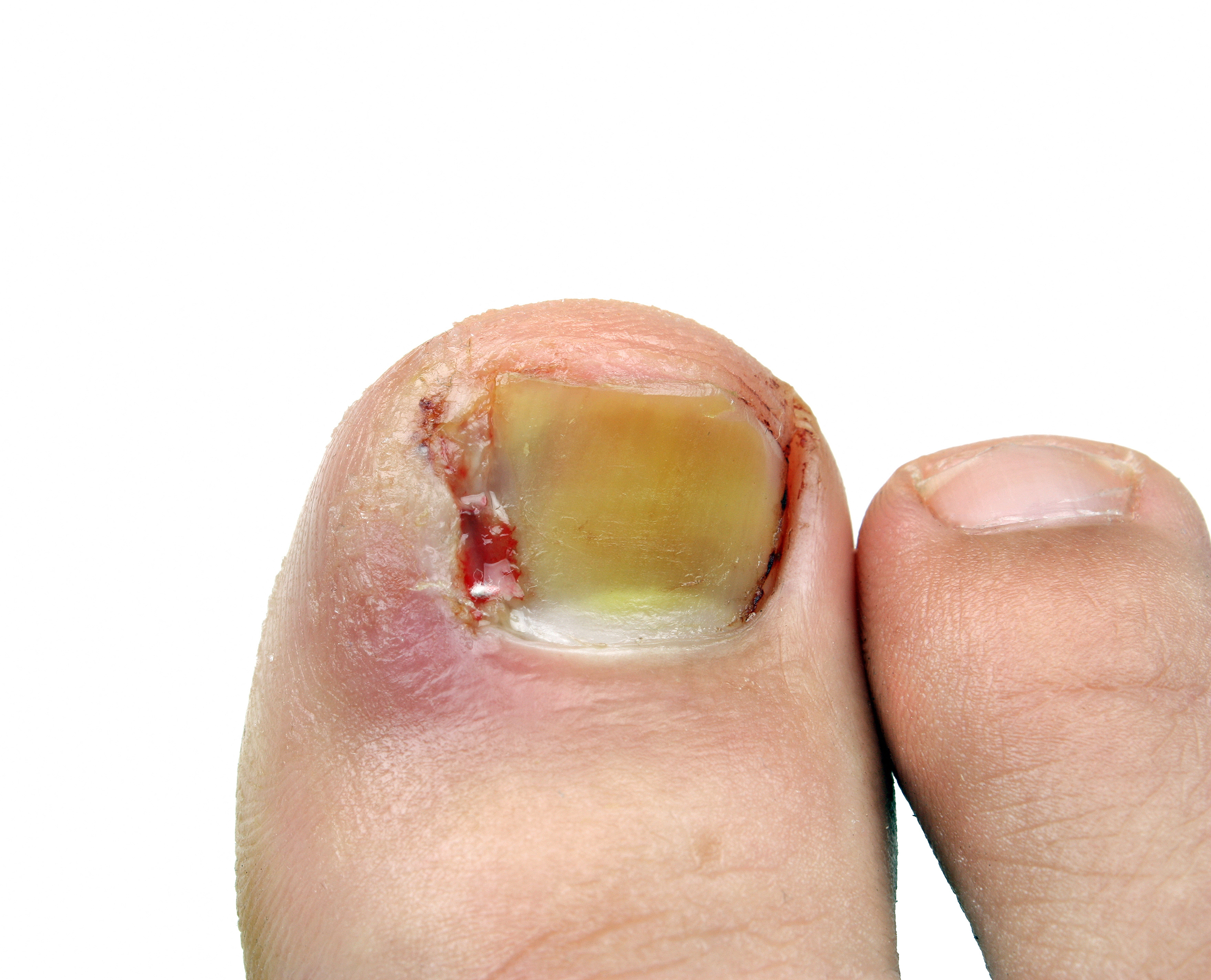 Ingrown Toenails - Foot and Ankle Wellness Centre