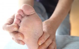 A person with athlete's foot grasping their foot.
