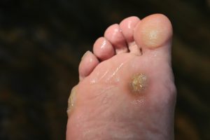 A photo of callouses and corns on a single foot.,