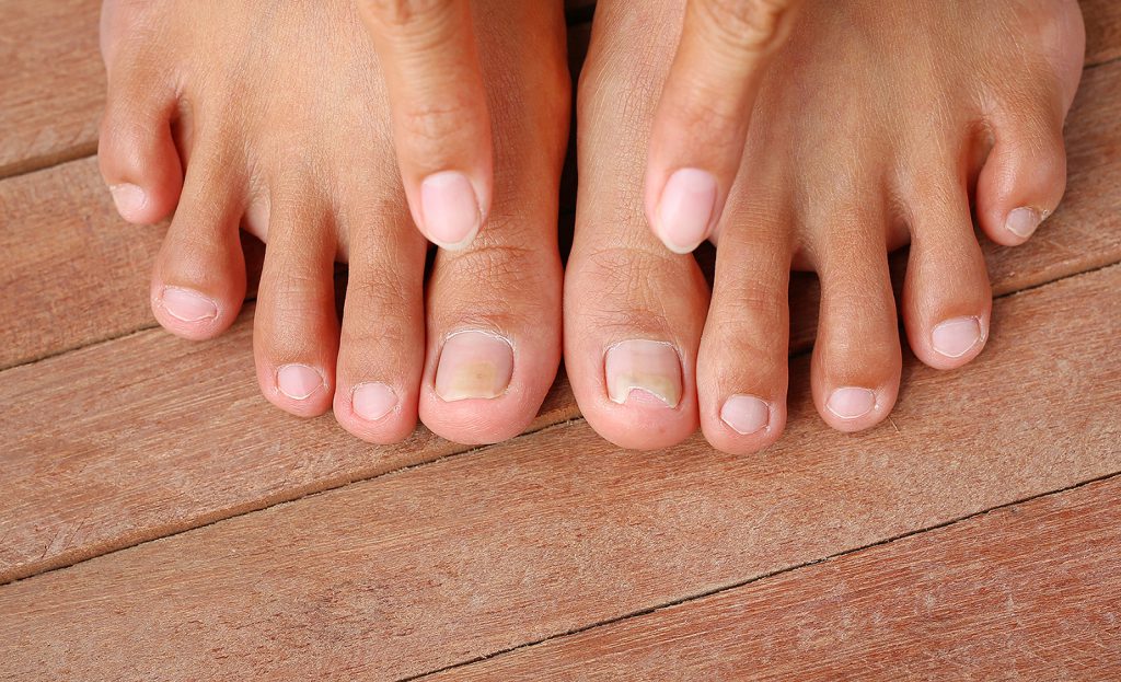 Thick Discoloured Toenails