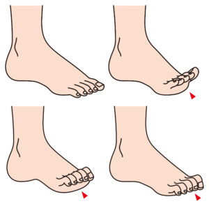 Hammertoe, Valley Foot Ankle Center