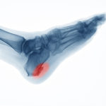 interior-heel-spurs-1