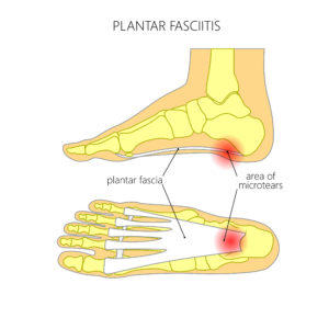 interior-plantar-fasciitis-1