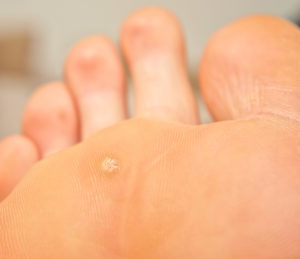 interior-plantar-warts-1