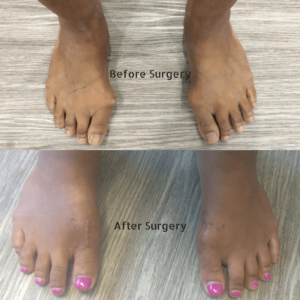 5 Best Bunion Exercises  Before or After Surgery — Feet&Feet