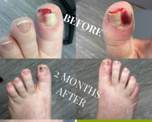 Private Ingrown Toenail Surgery Services