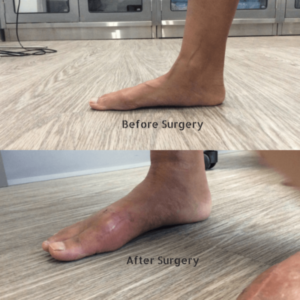 Flat foot reconstruction Surgery