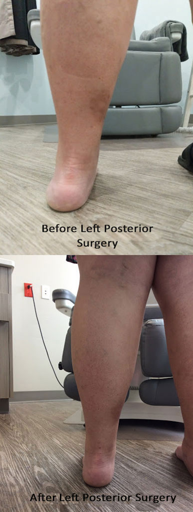 Before and After surgery of Flat foot correction 