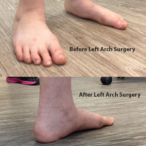 Before and After Left Arch surgery