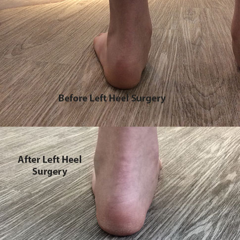 Before and After Left Heel surgery