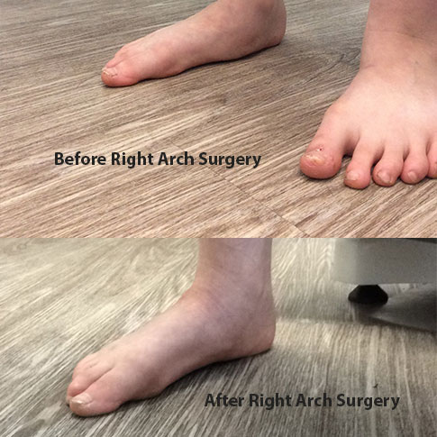 Before and After Right Arch surgery