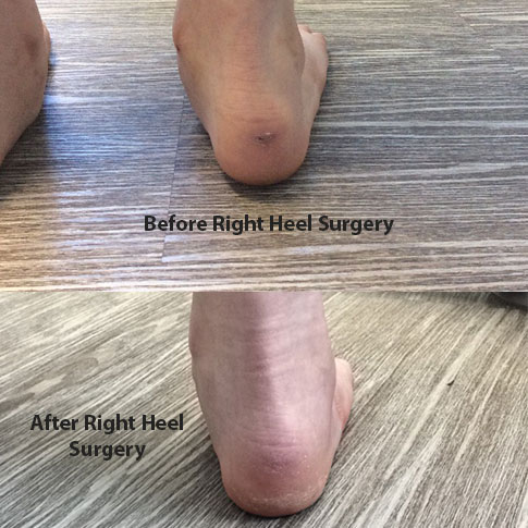 Before and After Right Heel surgery